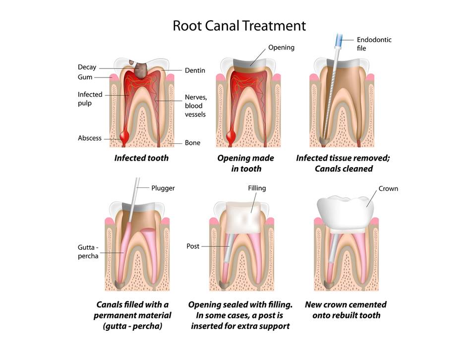 root canal therapy santa cruz